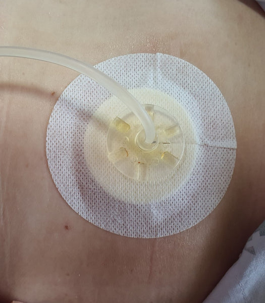 How to Care for a Catheter Dressing Change At Home