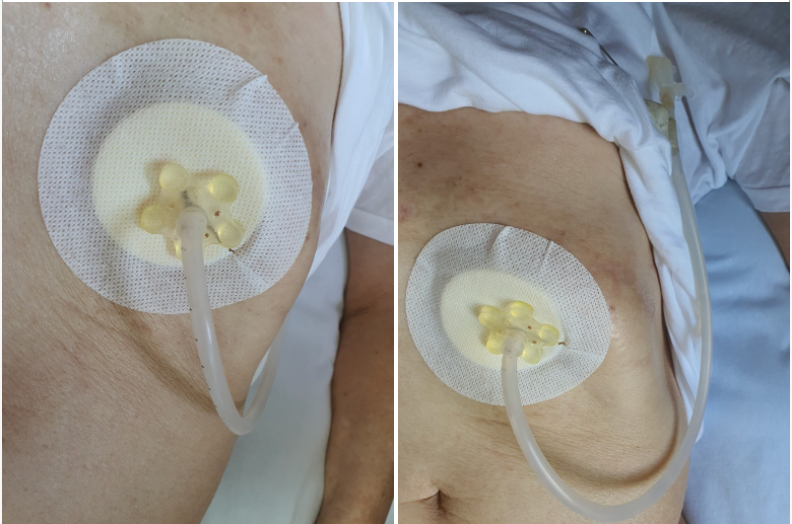 Applying CATH DRESSING for PEG (User Story)